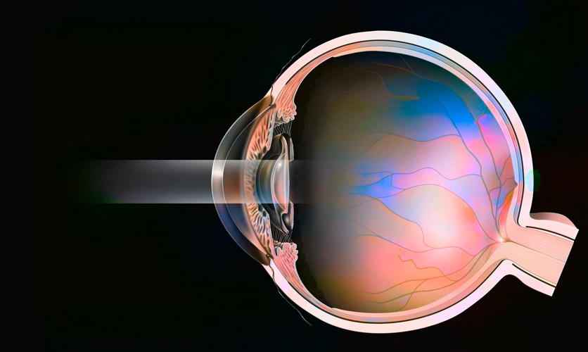 Illustration einer Laserbehandlung am Auge.